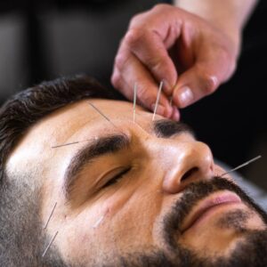 Akupunktur