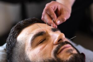 Akupunktur